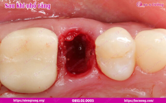 lo-hong-sau-khi-nho-rang-bac-si-cuong-bscuong